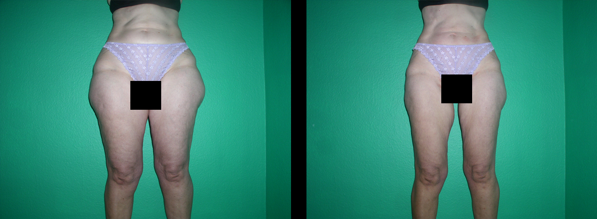 vor und nach 18 Behandlungen