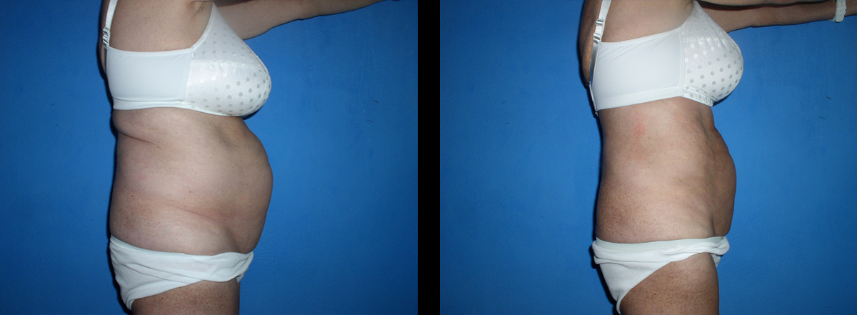 vor und nach 20 Behandlungen