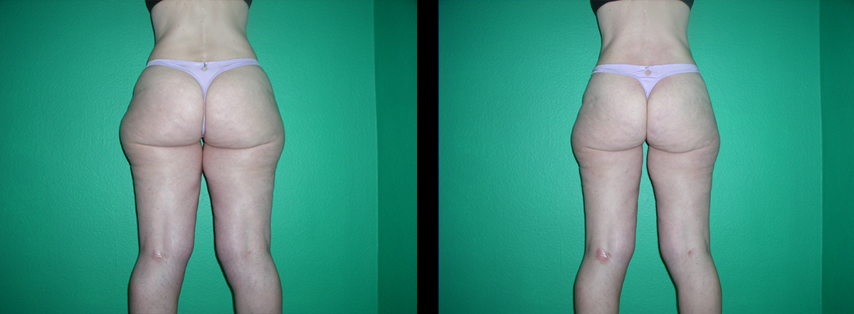 vor und nach 18 Behandlungen